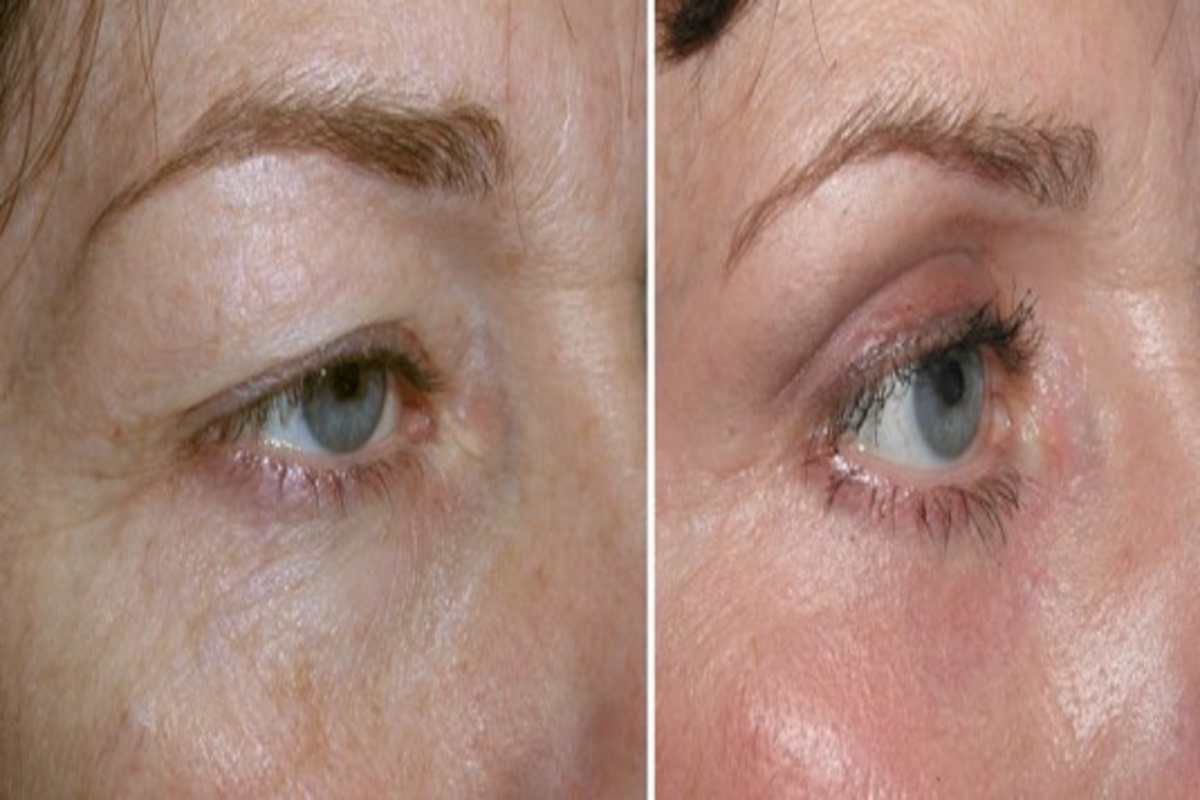 Blepharoplasty (Eyelid Surgery)