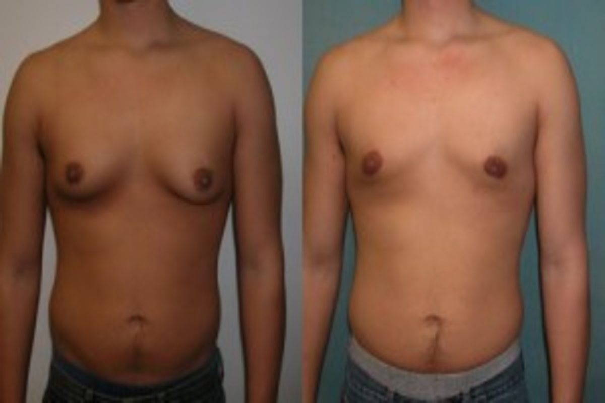 Gynaecomastia