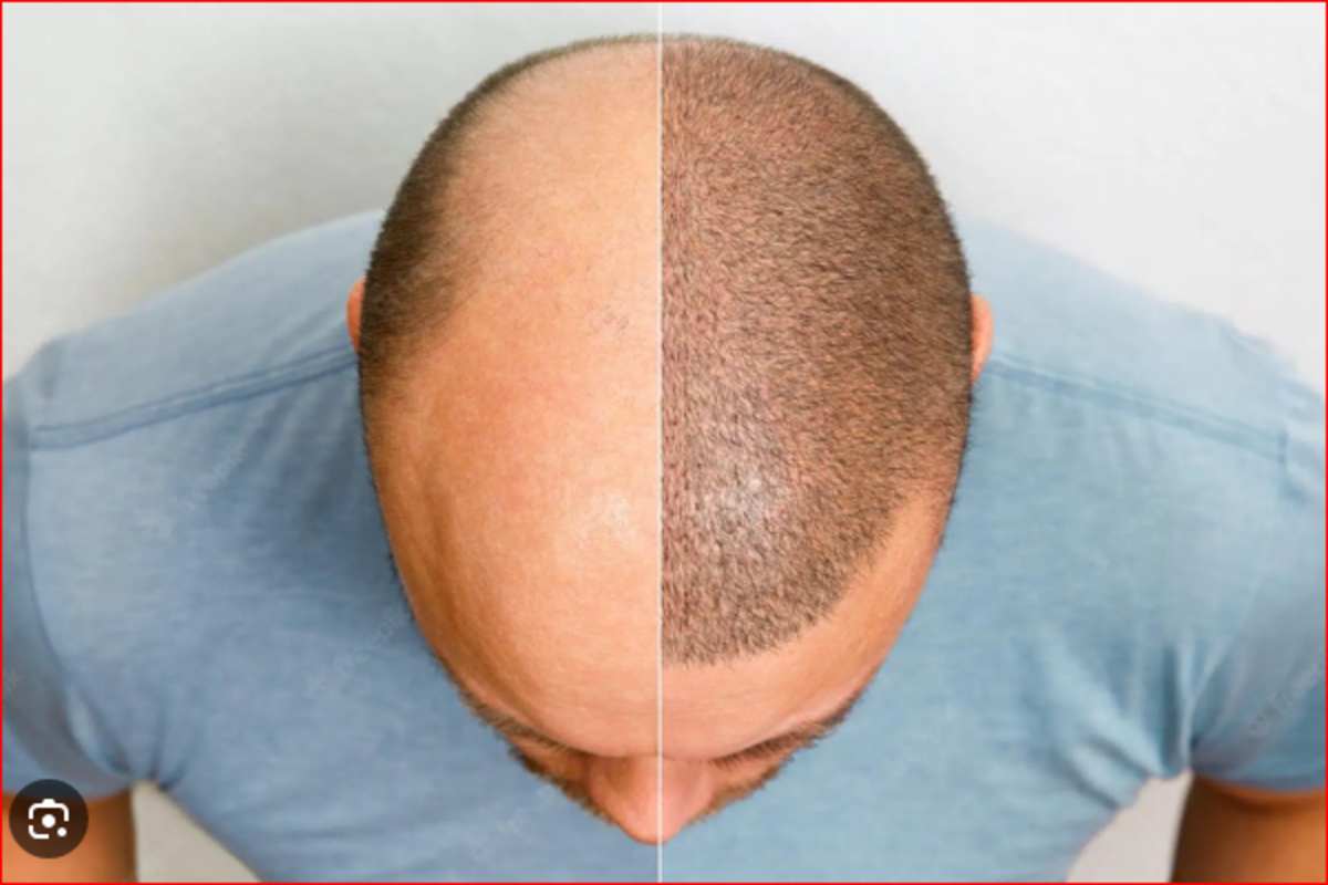 Hair Transplant