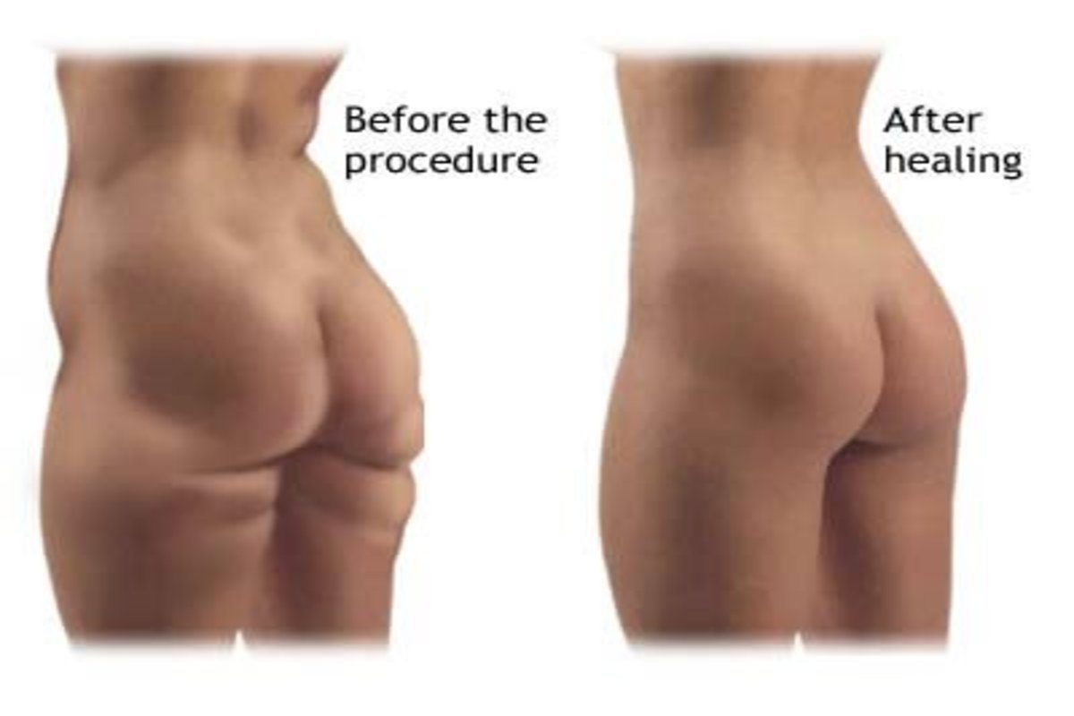 Liposuction