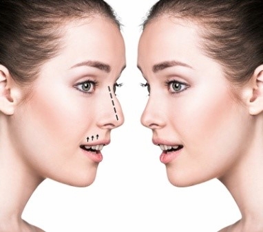 Rhinoplasty (Nose Job)