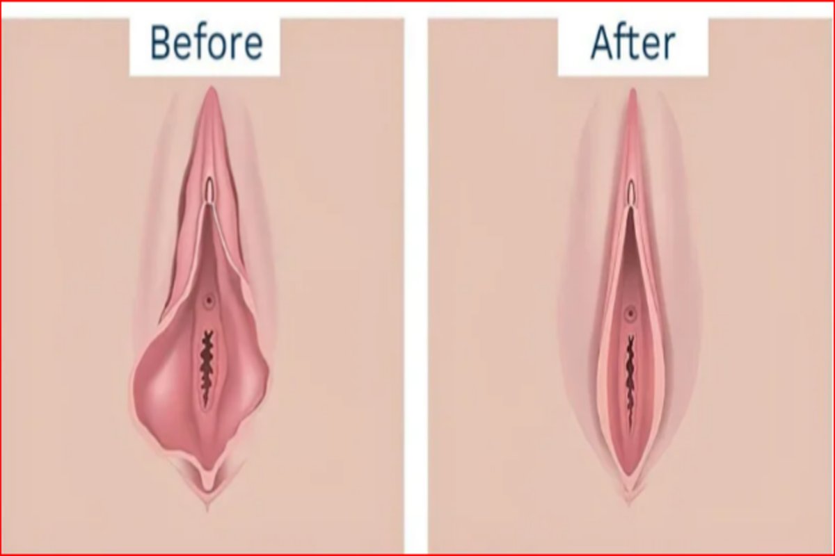 Vaginoplasty
