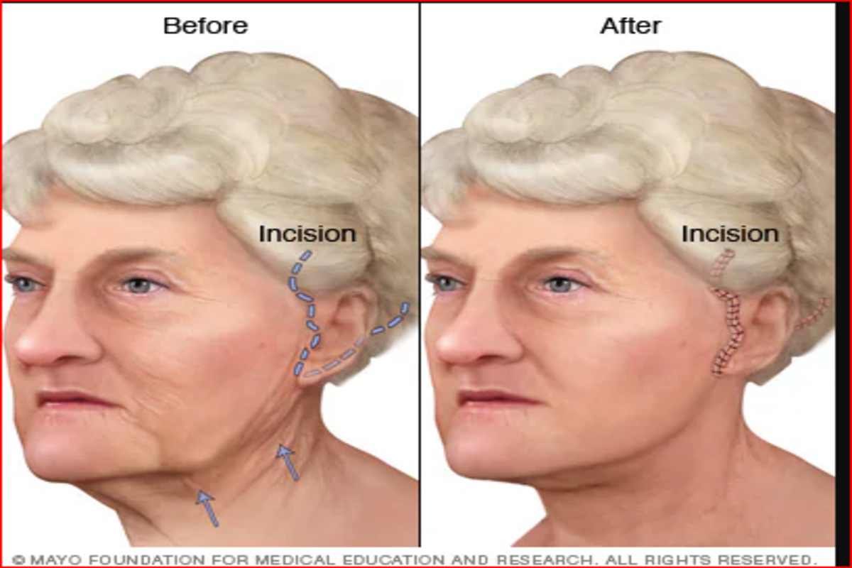 Face Lift