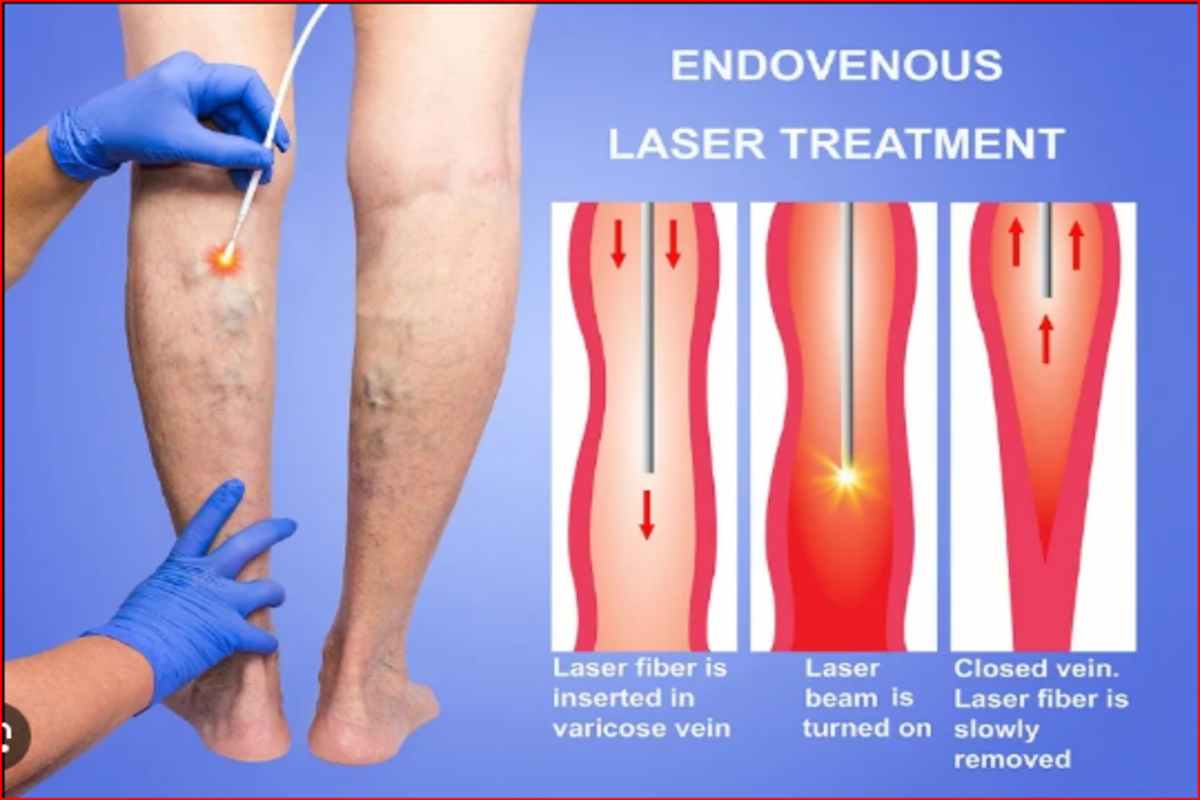 Varicose Veins Treatment