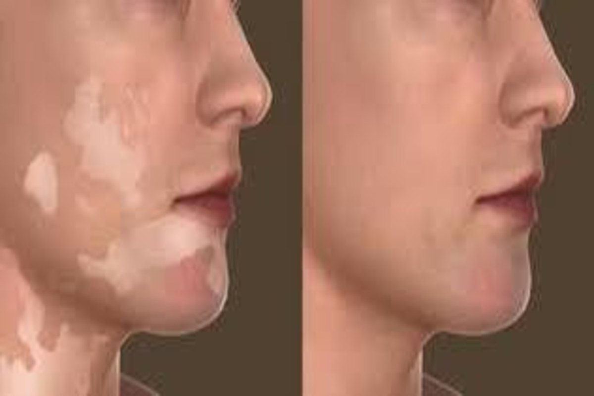 Vitiligo Surgery